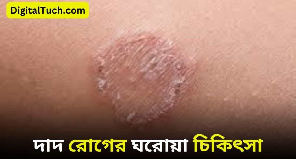 দাদ রোগের ঘরোয়া চিকিৎসা